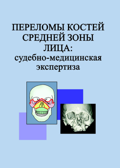 Скачать книгу Переломы костей средней зоны лица: судебно-медицинская экспертиза