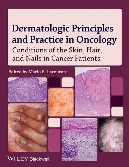Скачать книгу Dermatologic Principles and Practice in Oncology. Conditions of the Skin, Hair, and Nails in Cancer Patients
