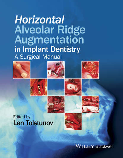 Скачать книгу Horizontal Alveolar Ridge Augmentation in Implant Dentistry. A Surgical Manual