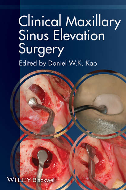 Скачать книгу Clinical Maxillary Sinus Elevation Surgery