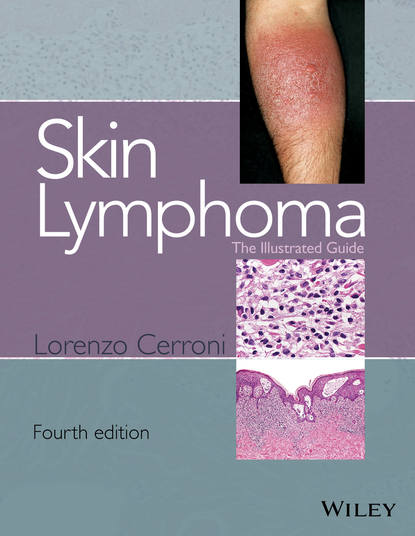Скачать книгу Skin Lymphoma. The Illustrated Guide
