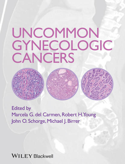 Скачать книгу Uncommon Gynecologic Cancers