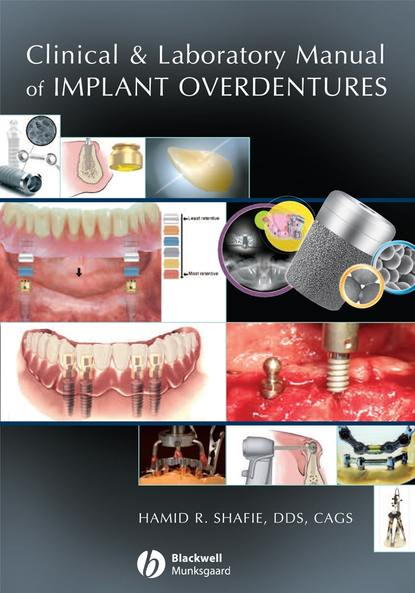 Скачать книгу Clinical and Laboratory Manual of Implant Overdentures