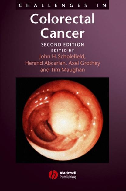 Скачать книгу Challenges in Colorectal Cancer