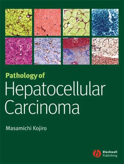 Скачать книгу Pathology of Hepatocellular Carcinoma