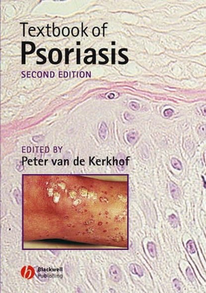 Скачать книгу Textbook of Psoriasis