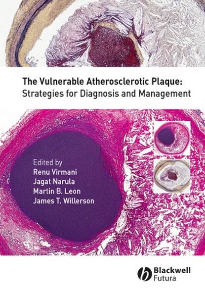 Скачать книгу The Vulnerable Atherosclerotic Plaque