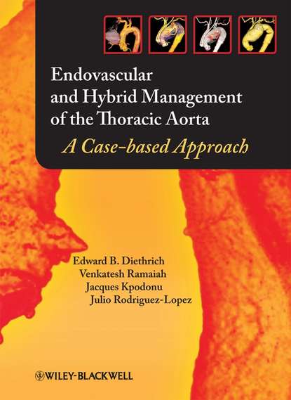 Скачать книгу Endovascular and Hybrid Management of the Thoracic Aorta
