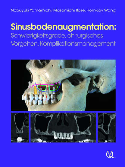 Скачать книгу Sinusbodenaugmentation