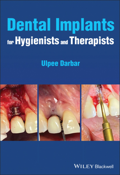 Скачать книгу Dental Implants for Hygienists and Therapists