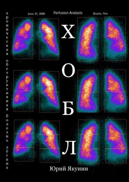 Скачать книгу ХОБЛ. Хроническая обструктивная болезнь лёгких