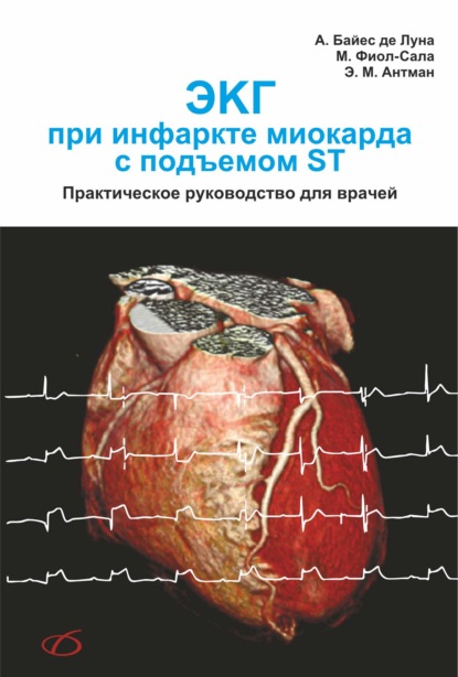 Скачать книгу ЭКГ при инфаркте миокарда с подъемом ST