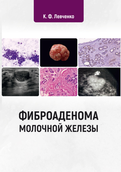Скачать книгу Фиброаденома молочной железы