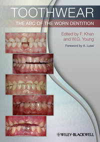 Toothwear. The ABC of the Worn Dentition