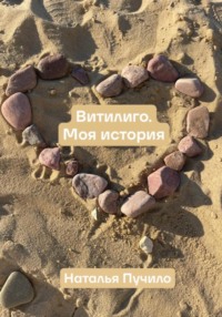 Витилиго. Моя история