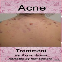 Acne Treatment
