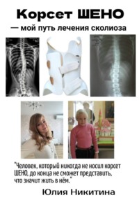 Корсет Шено. Мой путь лечения сколиоза