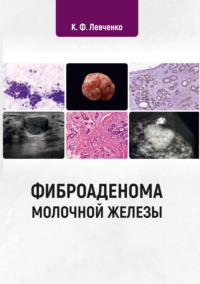 Фиброаденома молочной железы